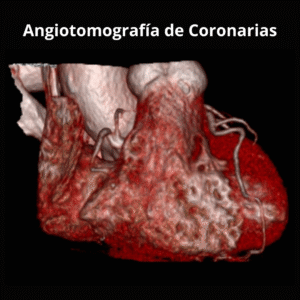 Angiotomografia de Coronarias 1