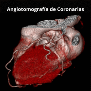 Angiotomografia de Coronarias 2