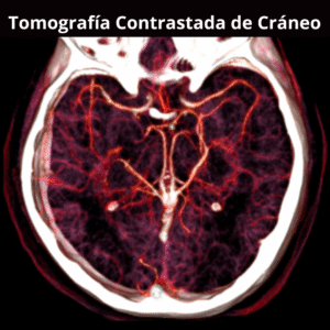 Tomografia Contrastada de Craneo