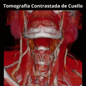 Tomografia Contrastada de Cuello 1