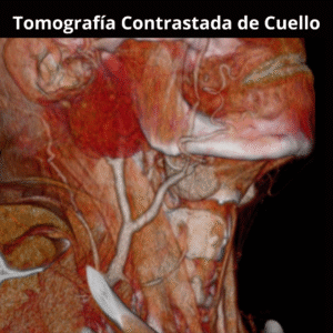 Tomografia Contrastada de Cuello 2