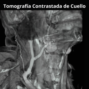 Tomografia Contrastada de Cuello 3
