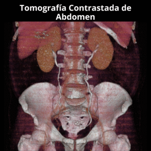 Tomografia Contrastada de abdomen 2