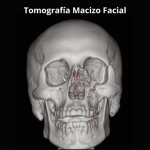 Tomografia Macizo Facial