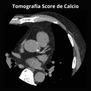 Tomografia Score de Calcio