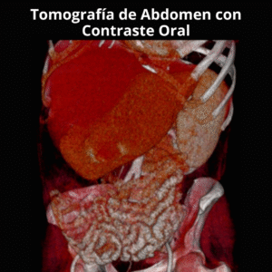 Tomografia de Abdomen con Contraste Oral 1