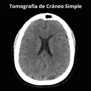 Tomografia de Craneo Simple 1