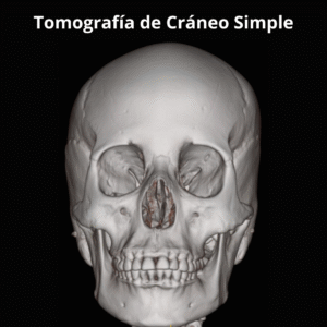 Tomografia de Craneo Simple 2
