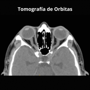 Tomografia de Orbitas 1