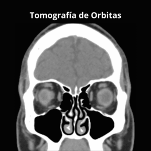 Tomografia de Orbitas 2