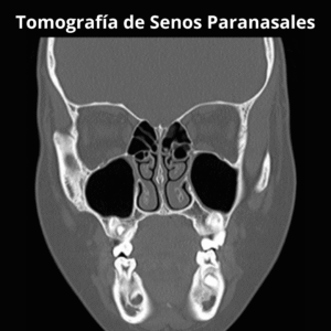 Tomografia de Senos Paranasales