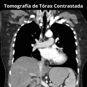 Tomografia de Torax Contrastada