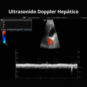 Ultrasonido Doppler Hepatico 1
