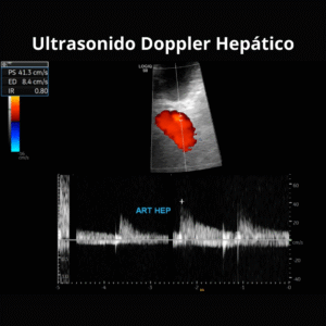 Ultrasonido Doppler Hepatico 2