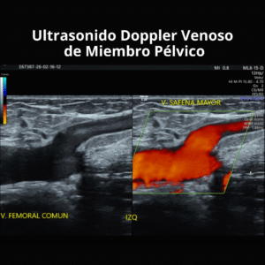 Ultrasonido Doppler Venoso de Miembro Pelvico 1