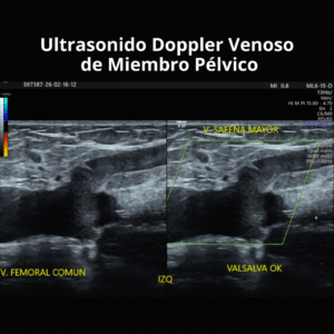 Ultrasonido Doppler Venoso de Miembro Pelvico 2