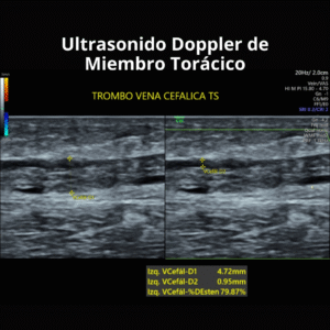 Ultrasonido Doppler de Miembro Toracico