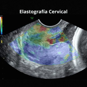 Ultrasonido Elastografia Cervical 1