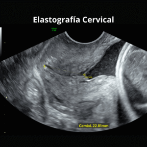 Ultrasonido Elastografia Cervical 2