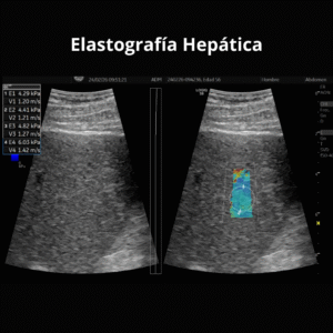 Ultrasonido Elastografia Hepatica