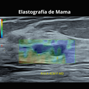 Ultrasonido Elastografia de Mama 1