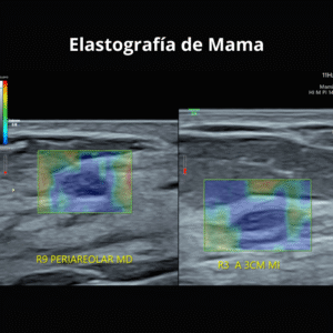 Ultrasonido Elastografia de Mama 2