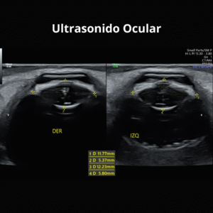 Ultrasonido Ocular 1