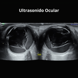 Ultrasonido Ocular 2