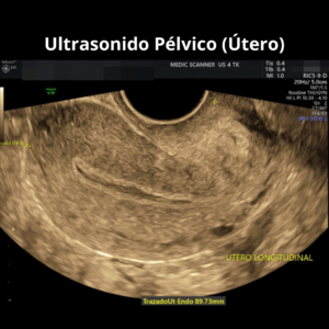 Ultrasonido Pelvico Utero
