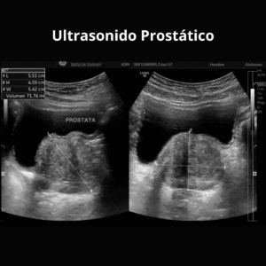 Ultrasonido Prostatico 1