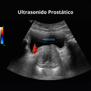 Ultrasonido Prostatico 2