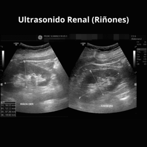 Ultrasonido Renal Rinones