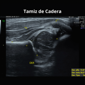 Ultrasonido Tamiz de Cadera 2