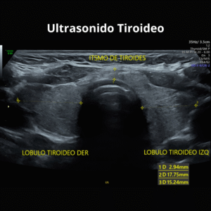 Ultrasonido Tiroideo 1
