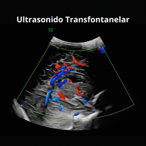 Ultrasonido Transfontanelar 1