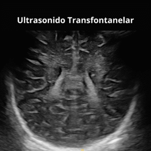 Ultrasonido Transfontanelar 2