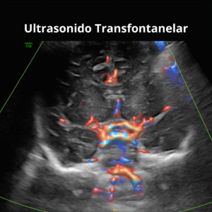Ultrasonido Transfontanelar 3
