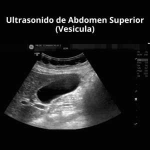 Ultrasonido de Abdomen Superior Vesicula