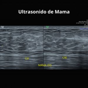 Ultrasonido de Mama 1