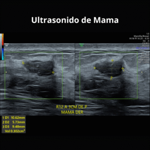 Ultrasonido de Mama 2