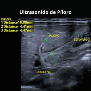 Ultrasonido de Piloro 1