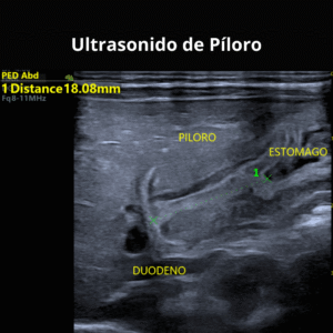 Ultrasonido de Piloro 2