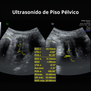 Ultrasonido de Piso Pelvico 1