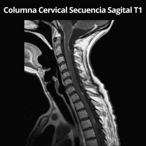 Resonancia Magnetica Columna Cervical Secuencia Sagital T1