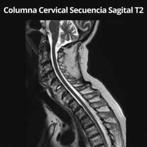 Resonancia Magnetica Columna Cervical Secuencia Sagital T2