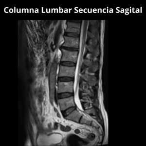 Resonancia Magnetica Columna Lumbar Secuencia Sagital