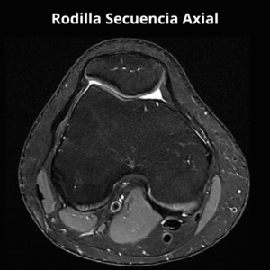Resonancia Magnetica Rodilla Secuencia Axial