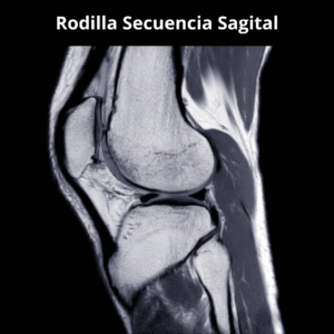 Resonancia Magnetica Rodilla Secuencia Sagital