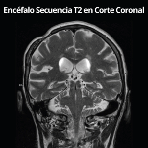 Resonancia Magnetica de Encefalo Secuencia T2 en Corte Coronal