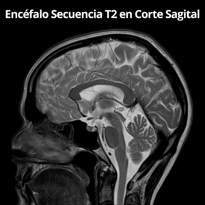 Resonancia Magnetica de Encefalo Secuencia T2 en Corte Sagital